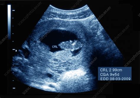 Intrauterine pregnancy, ultrasound scan - Stock Image - C055/2864 ...