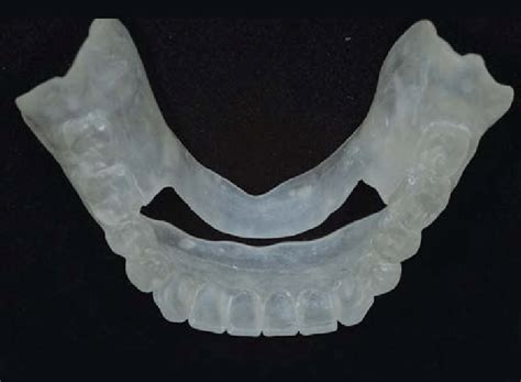 Replica of the lower denture in clear acrylic is relieved, where the... | Download Scientific ...