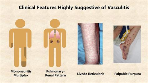 Vasculitis - An Overview - YouTube