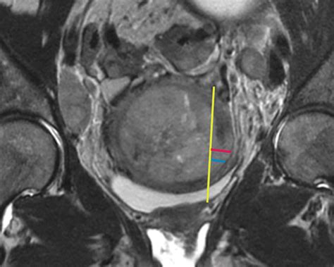 Update on MRI in Evaluation and Treatment of Endometrial Cancer ...