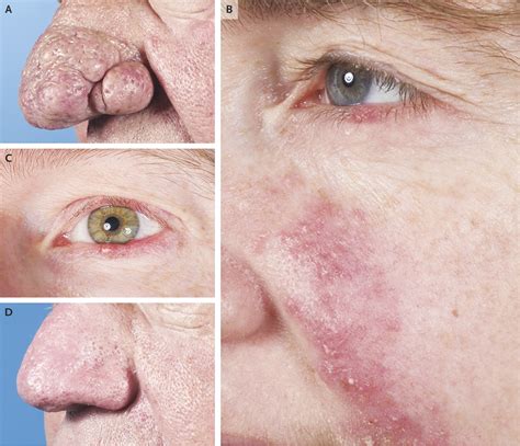 Rosacea Causes, Symptoms and Treatment | Mediologiest