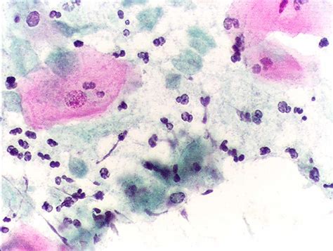 File:Pap test trichomonas.JPG - Wikipedia