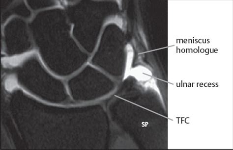 11 Triangular Fibrocartilage Complex | Radiology Key