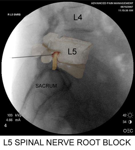 Decano tenis ramo de flores spinal nerve block Nacarado Hormiga Teoría ...