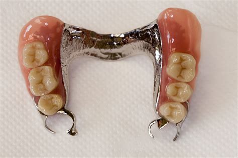 What are Partial Dentures - Pain Free Dental Clinic