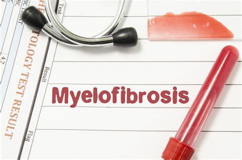 State of the Art: Novel Therapies for Myelofibrosis | Blood Cancers Today