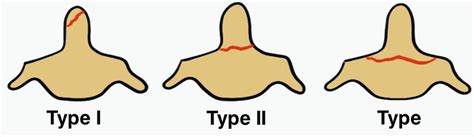 Dens / Odontoid Fracture | The Bone School