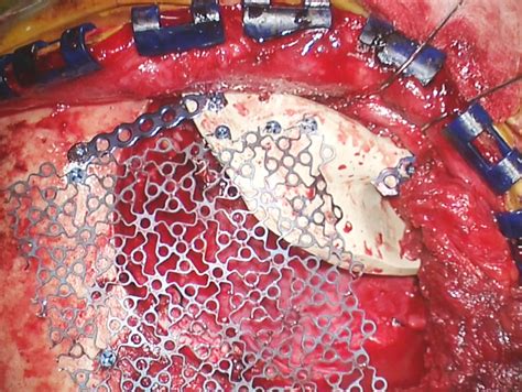 Lateral and Middle Sphenoid Wing Meningioma | The Neurosurgical Atlas, by Aaron Cohen-Gadol, M.D.