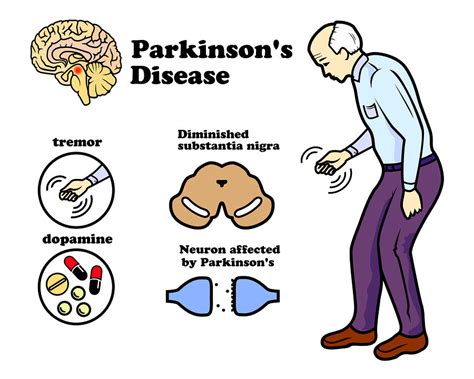 Parkinson Disease - PhysioHeal Best Physiotherapy Clinic in Gurgaon