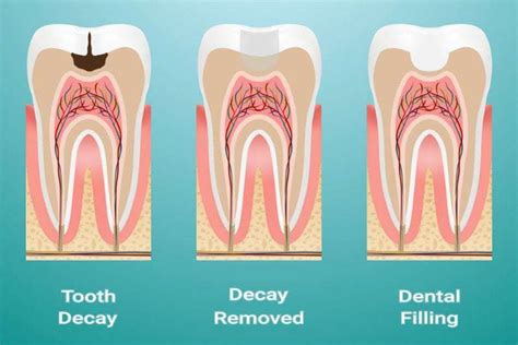 Dental Filling | filling services | free dental appointment | tooth cavity