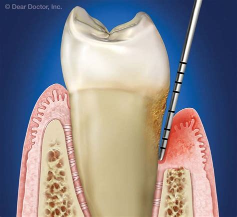 Understanding Periodontal Pockets | Periodontitis, Dental surgery, Dental videos