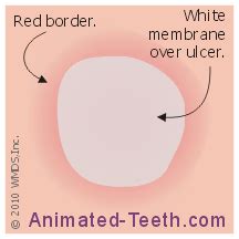 Your Guide to Canker Sore Stages & Identification | Pictures