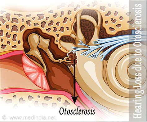 Otosclerosis Audiogram