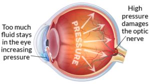 glaucoma_iop-intraocular-pressure_diagram - Eye Care Specialists Ophthalmology Services