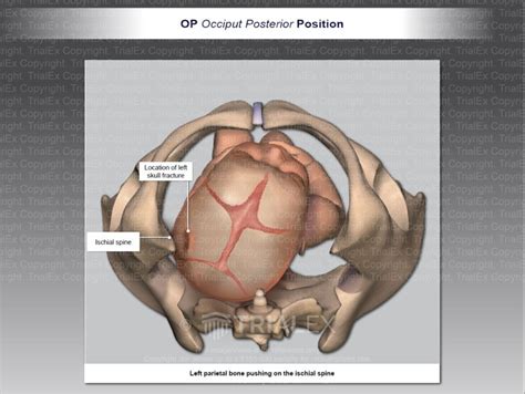 OP Occiput Posterior Position - TrialQuest Inc.