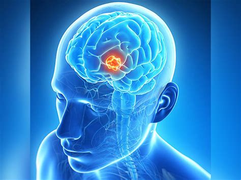 Glioblastoma: Causes, Symptoms, Diagnosis and Treatment - Boldsky.com