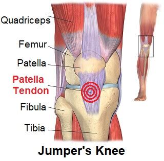 Patellar Tendonitis (Jumpers Knee): Symptoms, Diagnosis & Treatment