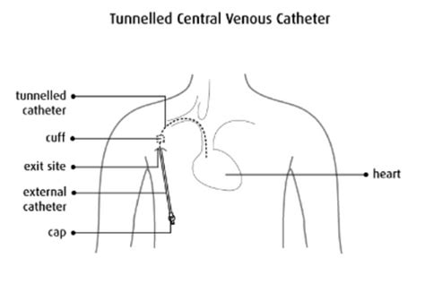 Ce sunt cateterele tunelate? - Care + Wear | Micro Blogs