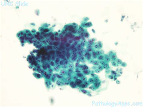 scc respiratory cytology