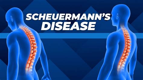 Top Three Exercises for Scheuermann's Disease - YouTube