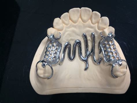 Co-Cr Metal Framework Removable Cast Partial Denture with Special ...