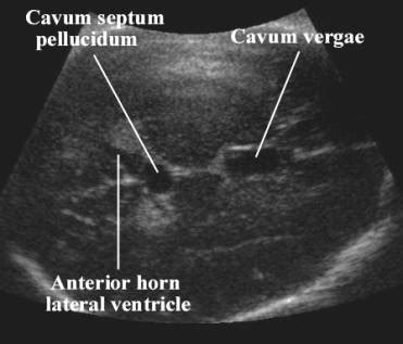 Radiology Update: Cavum septum pellucidum