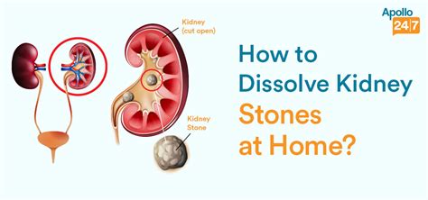 How to Dissolve Kidney Stones at Home?