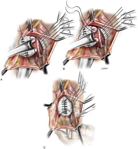 Surgical Management of Anterior Vaginal Wall Prolapse | Abdominal Key