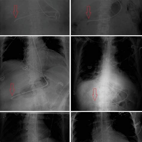 Ultrasonography-guided post-pyloric feeding tube insertion in medical ...