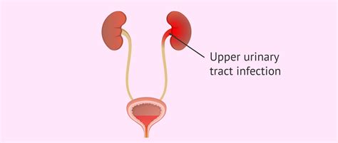 Upper urinary tract infection