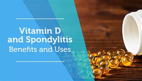 Treating Spondylitis | MySpondylitisTeam