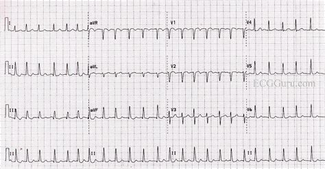 What Is Ventricular Fibrillation