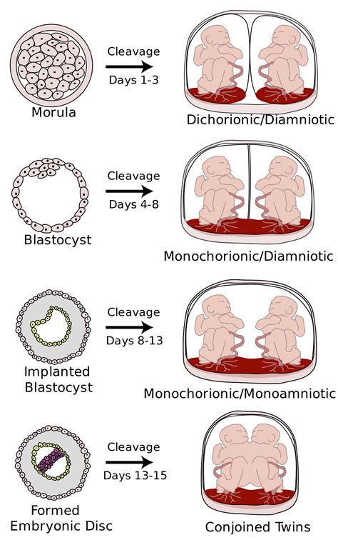 Monoamniotic twins - Wikipedia