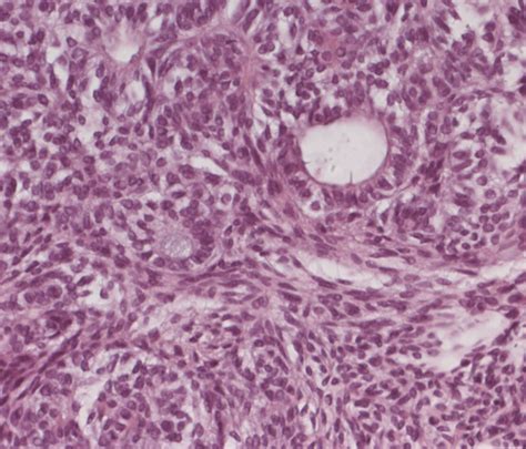 Calcifying Epithelial Odontogenic Tumor Histology