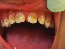 Baby Bottle Tooth Decay - Kids Smiles Pediatric DentistryKids Smiles Pediatric Dentistry