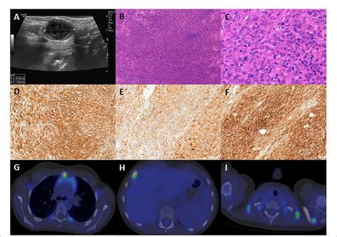 A) Ultrasound picture of the pathologic submandibular lymph node, size:... | Download Scientific ...