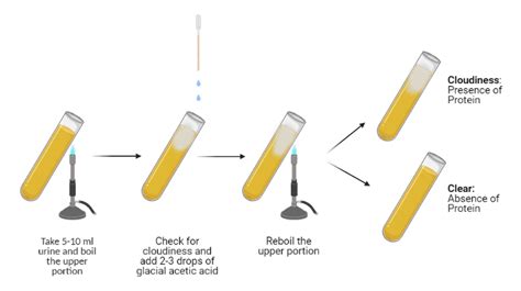 Heat and Acetic Acid Test for Proteinuria: Principle and Procedure