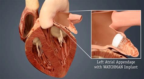 Heart Hospital First in State to Offer Watchman Heart Implant - Oklahoma's Nursing Times