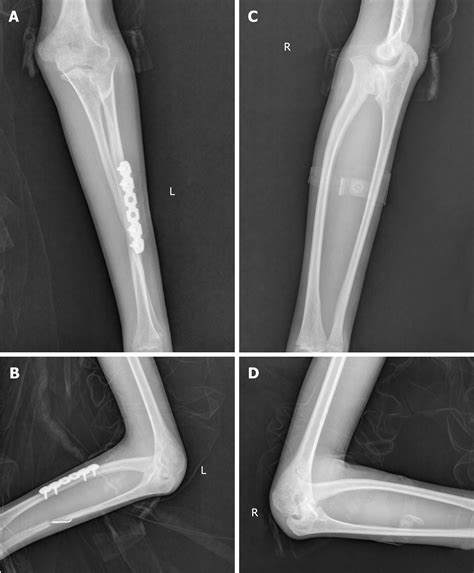 Unusual presentation of congenital radioulnar synostosis with ...