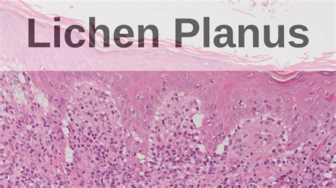 Oral Lichen Planus Histology