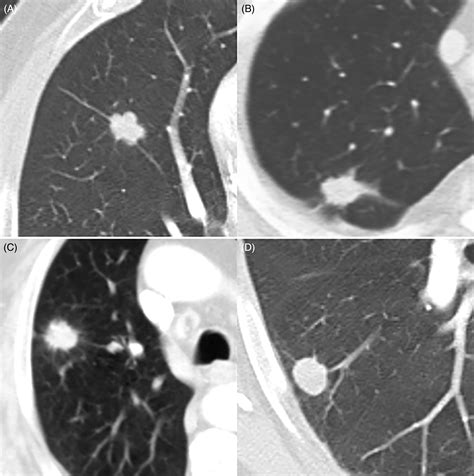 Ground Glass Opacity In Lungs Mayo Clinic - Glass Designs