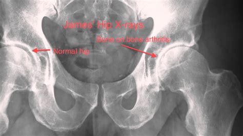 Classification Of Osteoarthritis