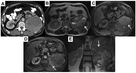 Late local, peritoneal and systemic recurrence of renal angiomyolipoma: A case report