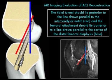 Dynamic Mri of ACL Reconstruction | coachingultrasound