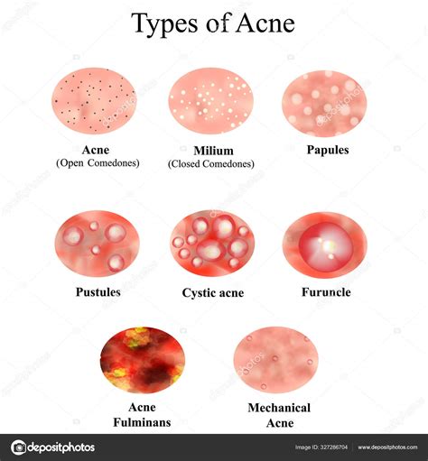 Papules And Pustules