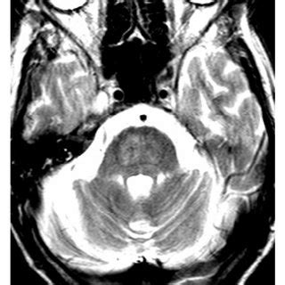 Diffusion weighted MRI image of our patient demonstrating central... | Download Scientific Diagram