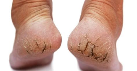 11 Of The Best Home Remedies For Dry Feet And Cracked Heels