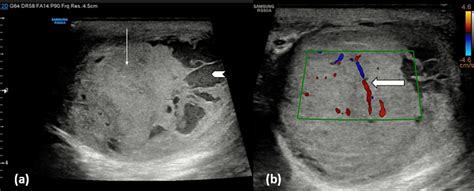 Diagnostic and Imaging Features of a Non-seminomatous Germ Cell Tumor of the Testis: A Case ...