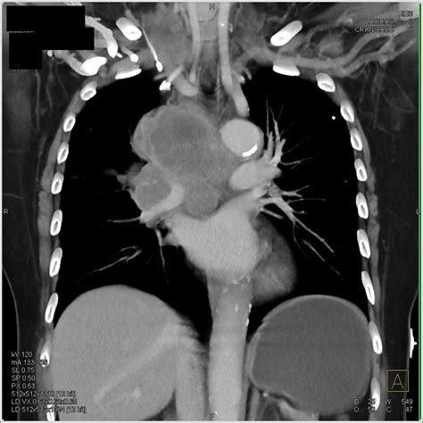 SVC Syndrome due to Small Cell Lung Cancer - Vascular Case Studies - CTisus CT Scanning