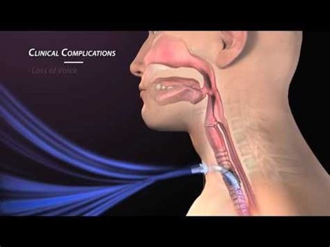 if the tube becomes DISLODGED... REPLACE IT right away! Clinical Complications of Tracheostomy ...